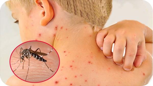 Cách phòng sốt xuất huyết khi mưa kéo dài 6 Cach phong sot xuat huyet khi mua keo dai